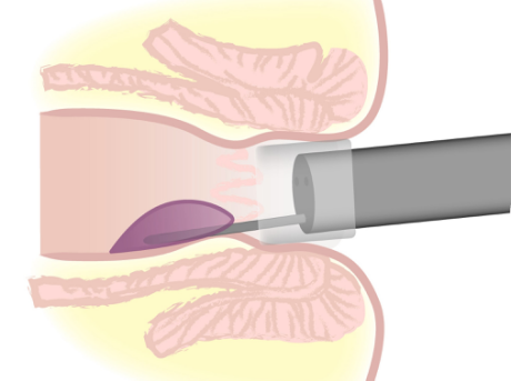痔瘡內(nèi)鏡下硬化治療術(shù) 幫助痔瘡患者擺脫痛苦