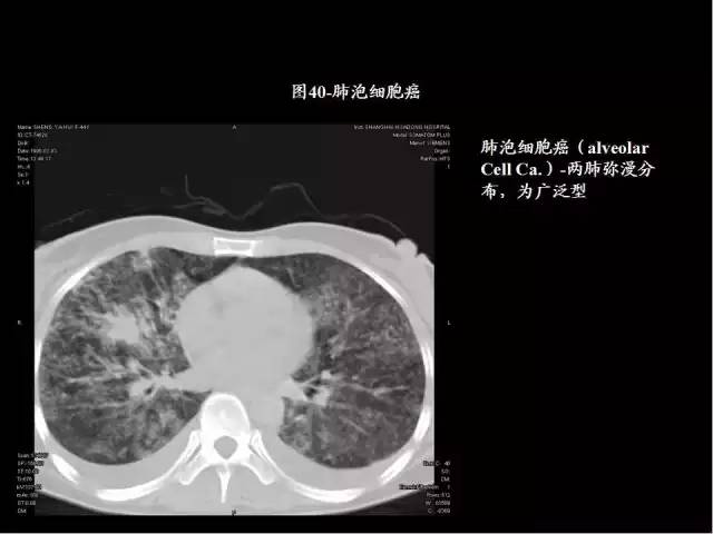 為什么做胸、腹部CT掃描時需要吸氣-屏氣-吐氣？