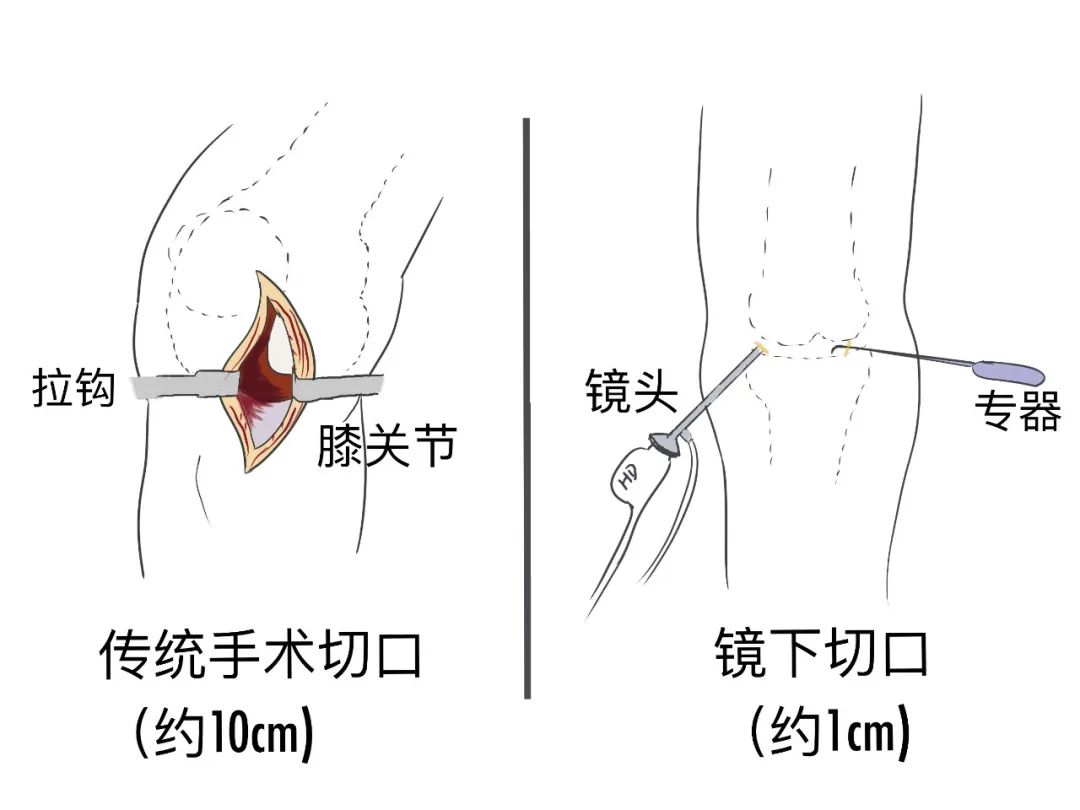 帶你一起認(rèn)識(shí)關(guān)節(jié)鏡